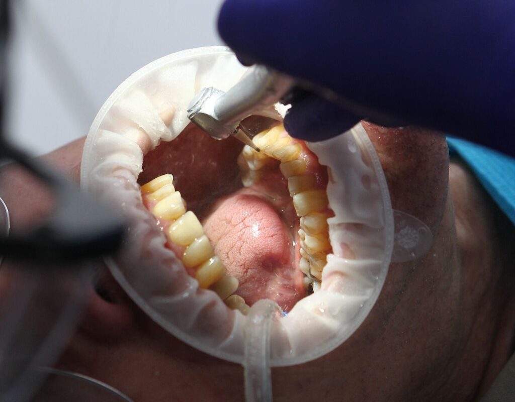 refaire ses dents